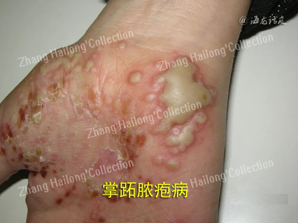 什么是窄谱紫外线治疗紫外线治疗皮肤病临床应用专家共识_https://www.jmylbn.com_新闻资讯_第10张