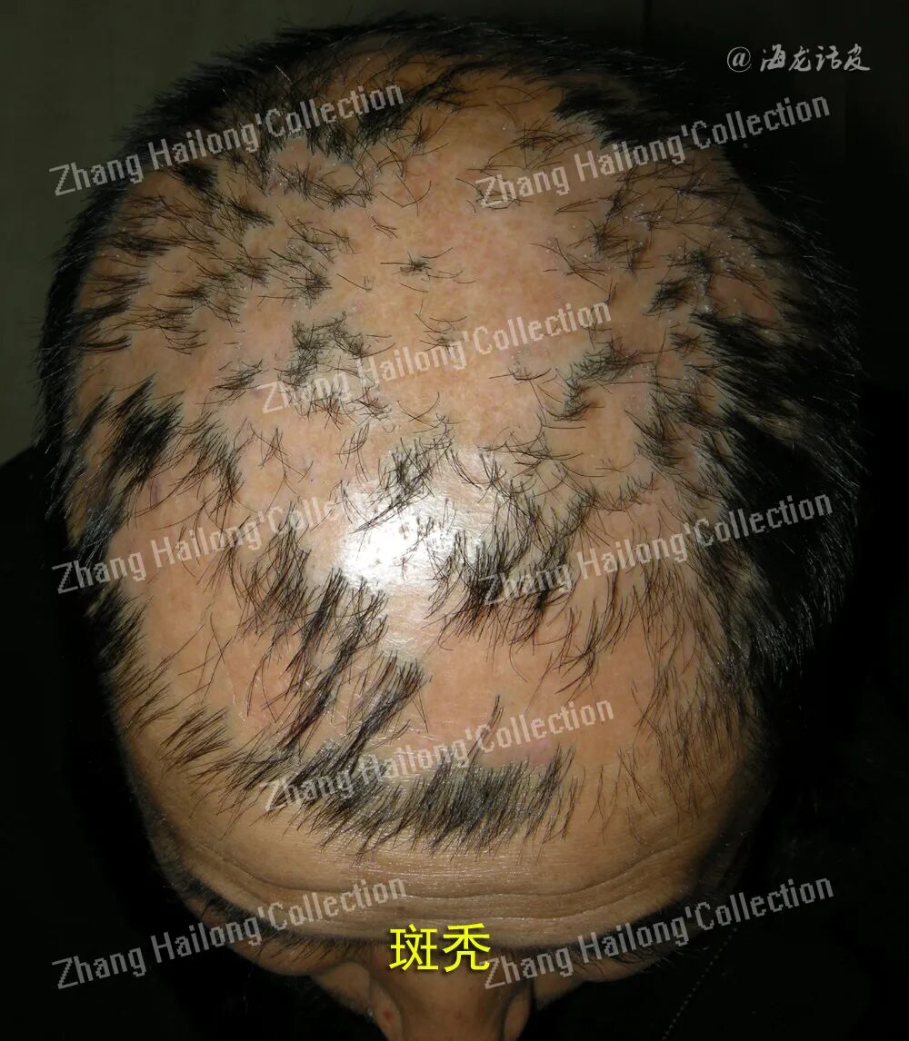 什么是窄谱紫外线治疗紫外线治疗皮肤病临床应用专家共识_https://www.jmylbn.com_新闻资讯_第3张