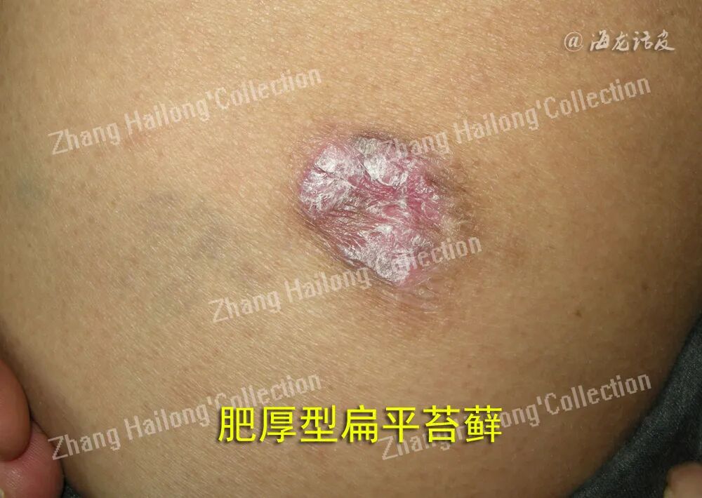 什么是窄谱紫外线治疗紫外线治疗皮肤病临床应用专家共识_https://www.jmylbn.com_新闻资讯_第2张