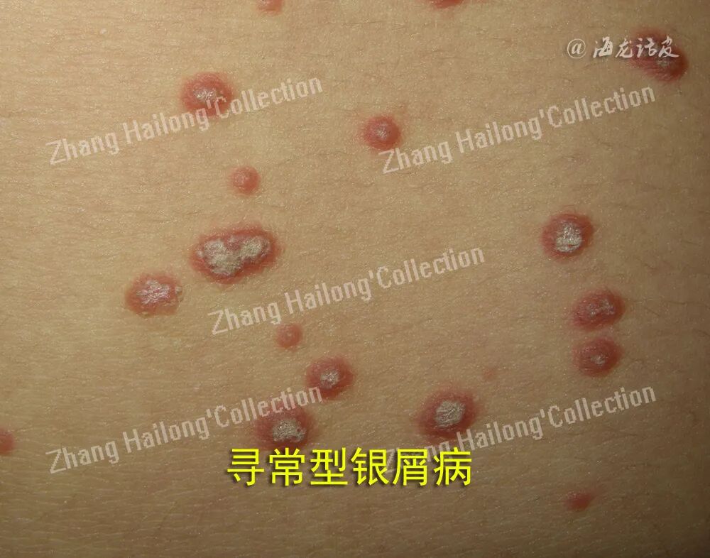 什么是窄谱紫外线治疗紫外线治疗皮肤病临床应用专家共识_https://www.jmylbn.com_新闻资讯_第7张