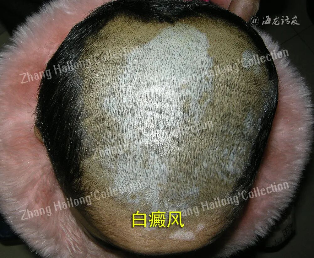 什么是窄谱紫外线治疗紫外线治疗皮肤病临床应用专家共识_https://www.jmylbn.com_新闻资讯_第14张