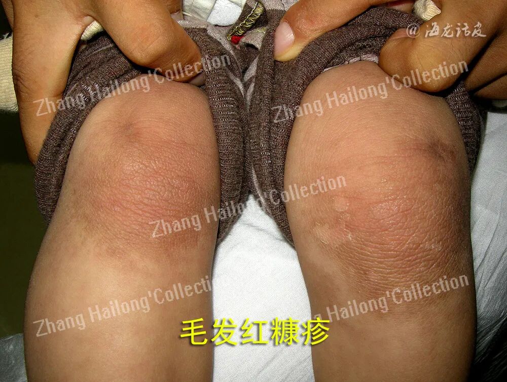 什么是窄谱紫外线治疗紫外线治疗皮肤病临床应用专家共识_https://www.jmylbn.com_新闻资讯_第5张