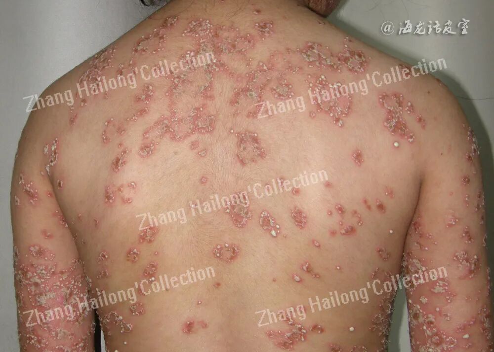 什么是窄谱紫外线治疗紫外线治疗皮肤病临床应用专家共识_https://www.jmylbn.com_新闻资讯_第1张