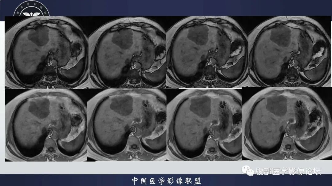 肝脏丨转移瘤影像表现