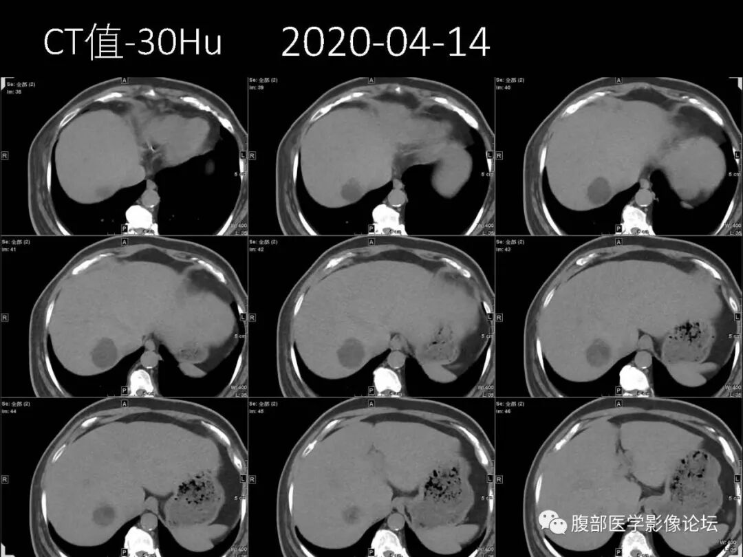 肝脏丨透明细胞癌的影像表现_医学界-助力医生临床决策和职业成长