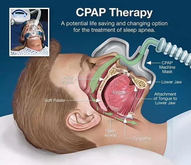 发明者:悉尼大学医学院的colin edward sulliva教授cpap呼吸机,是一种