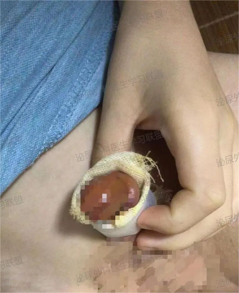 手术敷料包怎么包做好一台包皮手术：术后换药攻略_https://www.jmylbn.com_新闻资讯_第4张