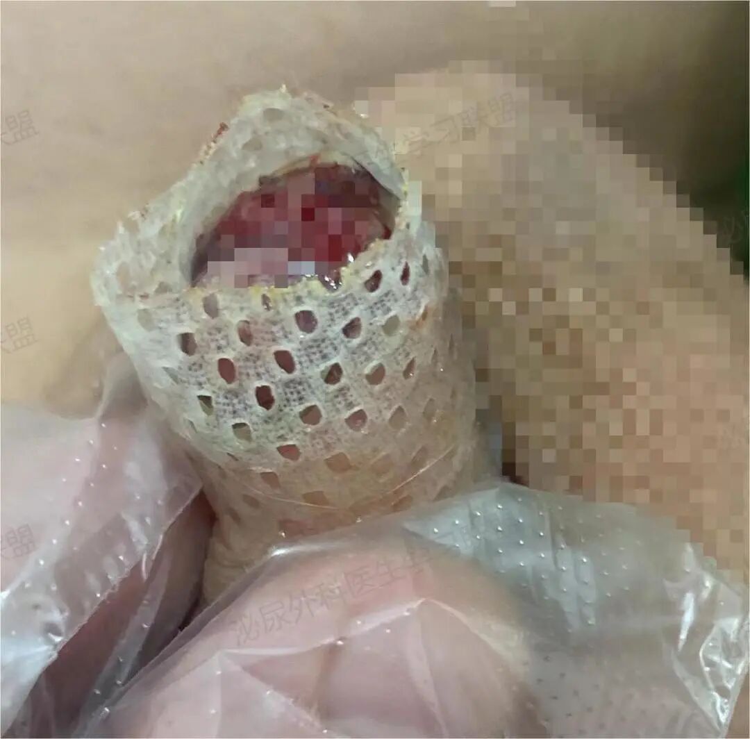 手术敷料包怎么包做好一台包皮手术：术后换药攻略_https://www.jmylbn.com_新闻资讯_第3张