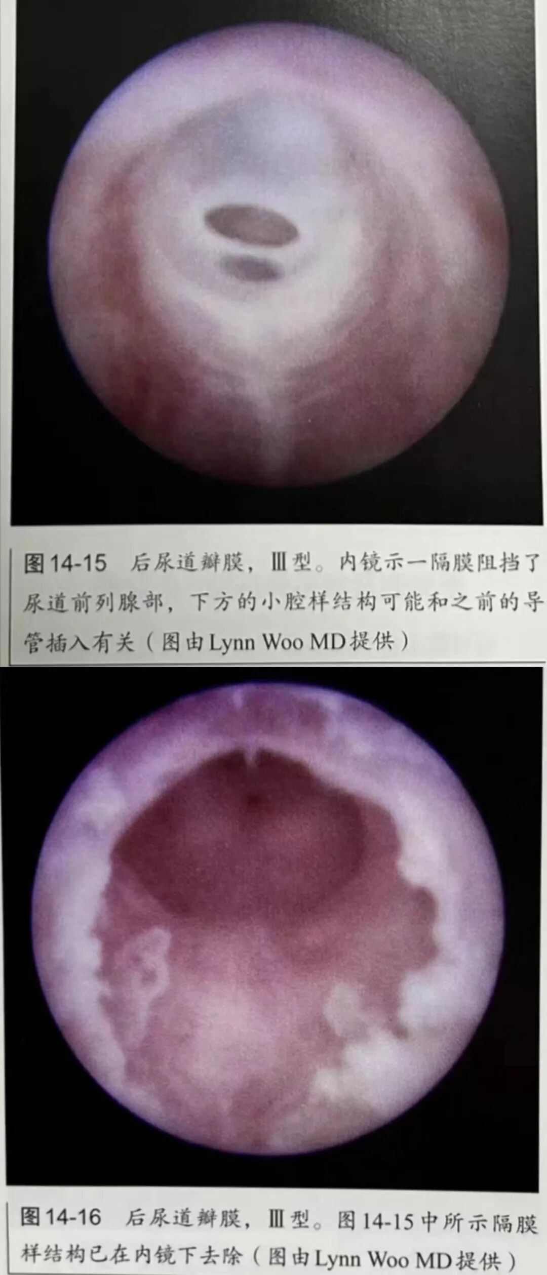 弯头导尿管怎么用尿管插不进去了，是退还是进？_https://www.jmylbn.com_新闻资讯_第9张