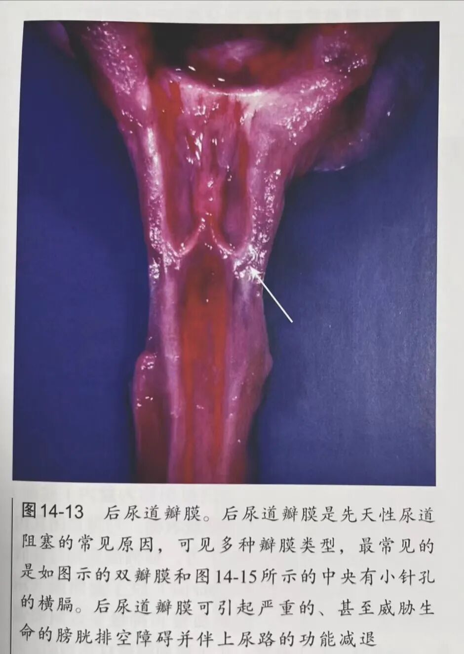 弯头导尿管怎么用尿管插不进去了，是退还是进？_https://www.jmylbn.com_新闻资讯_第8张