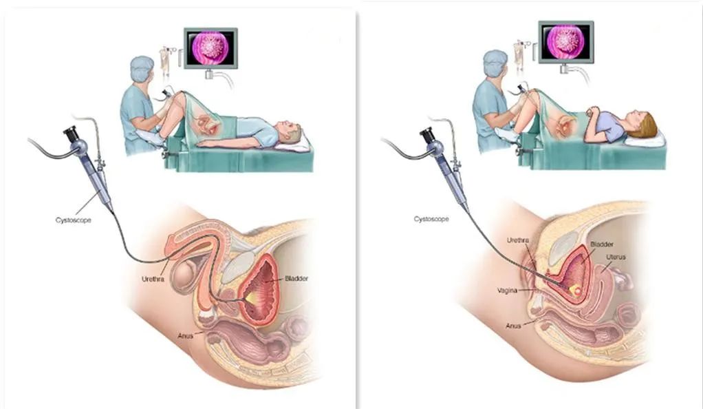 做膀胱镜过程图片图片