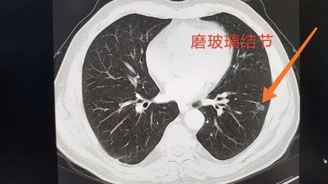 磨玻璃结节 磨玻璃结节