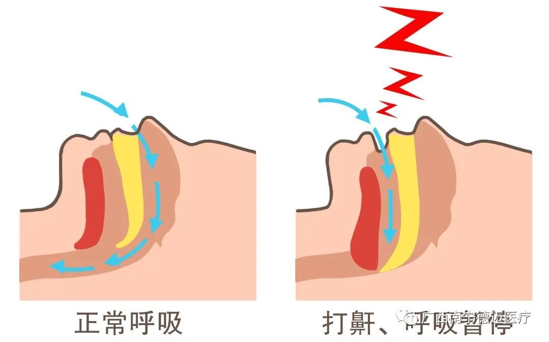 睡眠呼吸机怎么调节你问我答 ｜ 睡眠呼吸暂停综合症患者使用瑞迈特呼吸机的问题汇总_https://www.jmylbn.com_新闻资讯_第5张