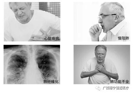 呼吸机怎么选干货 ｜ 如何正确选择合适的家用呼吸机？_https://www.jmylbn.com_新闻资讯_第5张