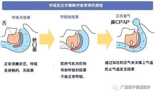 呼吸机怎么选干货 ｜ 如何正确选择合适的家用呼吸机？_https://www.jmylbn.com_新闻资讯_第4张