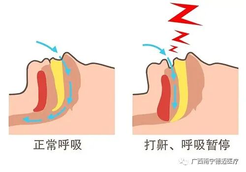 呼吸机怎么选干货 ｜ 如何正确选择合适的家用呼吸机？_https://www.jmylbn.com_新闻资讯_第7张