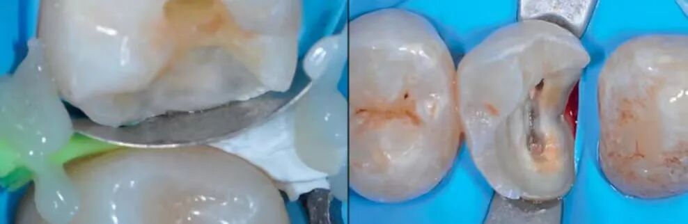 深边缘提升的再思考（龈壁提升的操作细节）