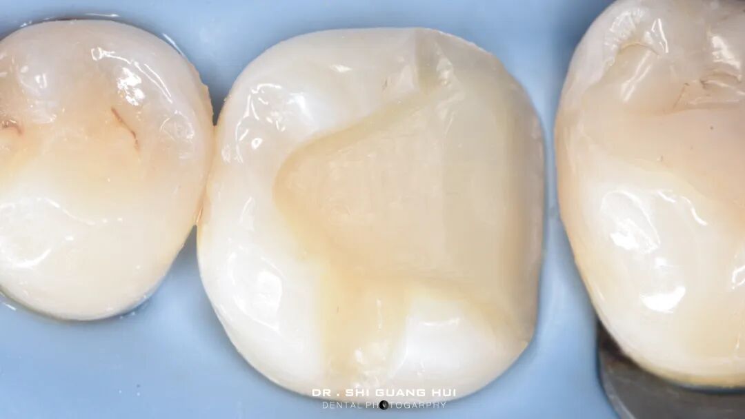 深边缘提升的再思考（龈壁提升的操作细节）