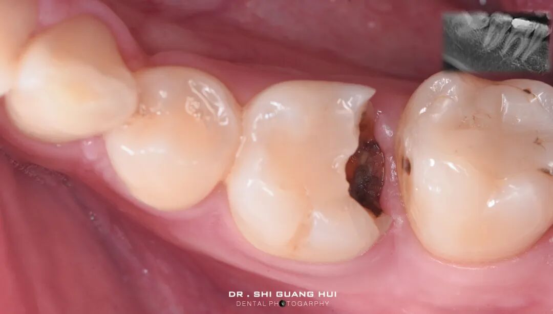 深边缘提升的再思考（龈壁提升的操作细节）