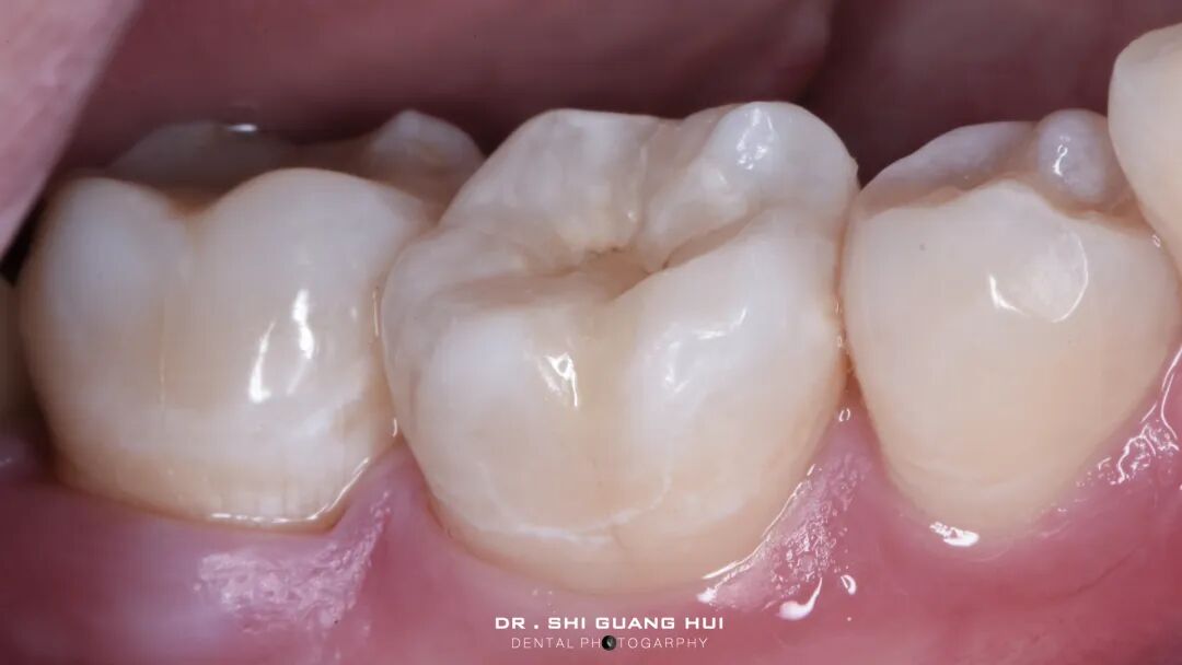 深边缘提升的再思考（龈壁提升的操作细节）