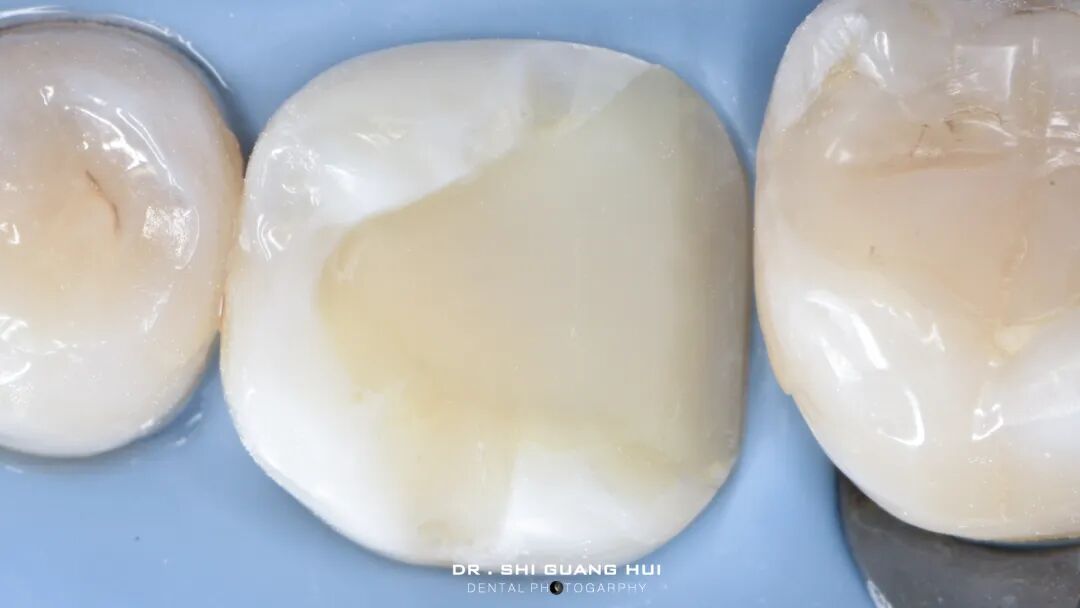 深边缘提升的再思考（龈壁提升的操作细节）