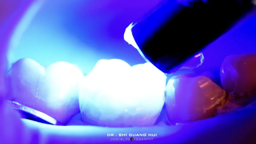 深边缘提升的再思考（龈壁提升的操作细节）