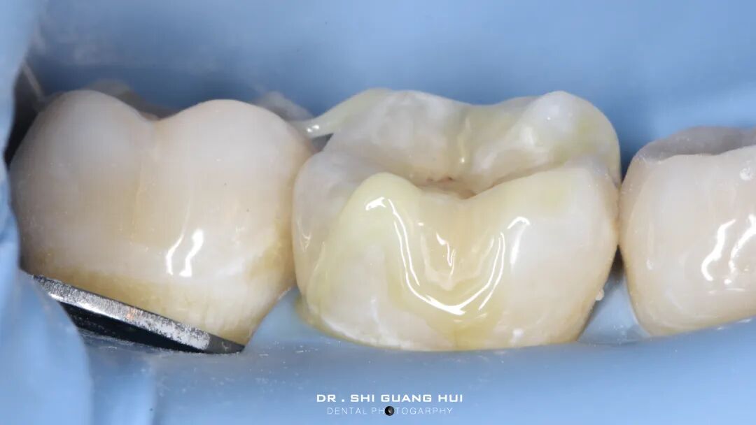 深边缘提升的再思考（龈壁提升的操作细节）