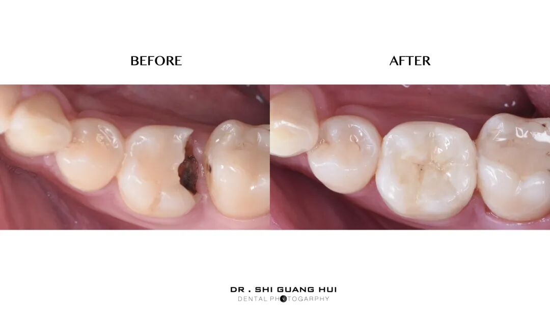 深边缘提升的再思考（龈壁提升的操作细节）