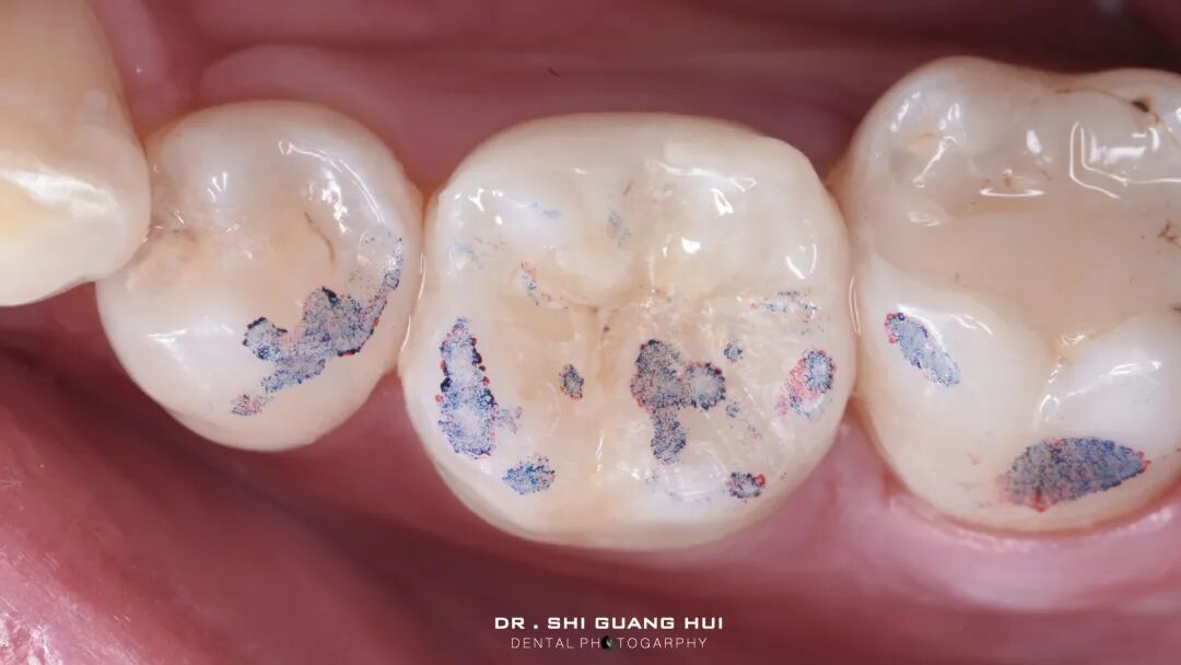 深边缘提升的再思考（龈壁提升的操作细节）