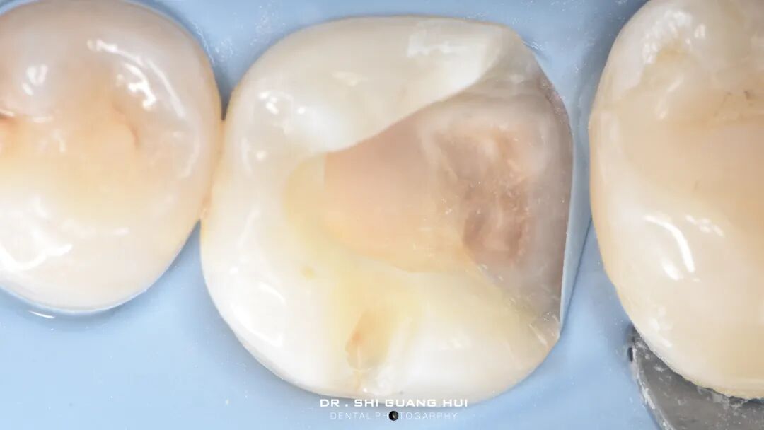 深边缘提升的再思考（龈壁提升的操作细节）