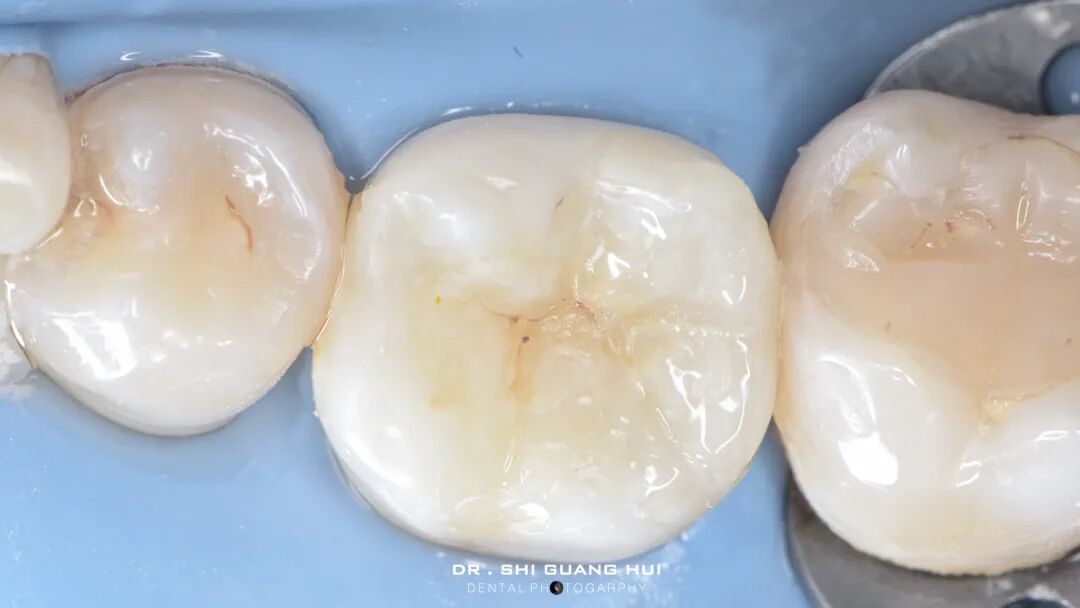 深边缘提升的再思考（龈壁提升的操作细节）