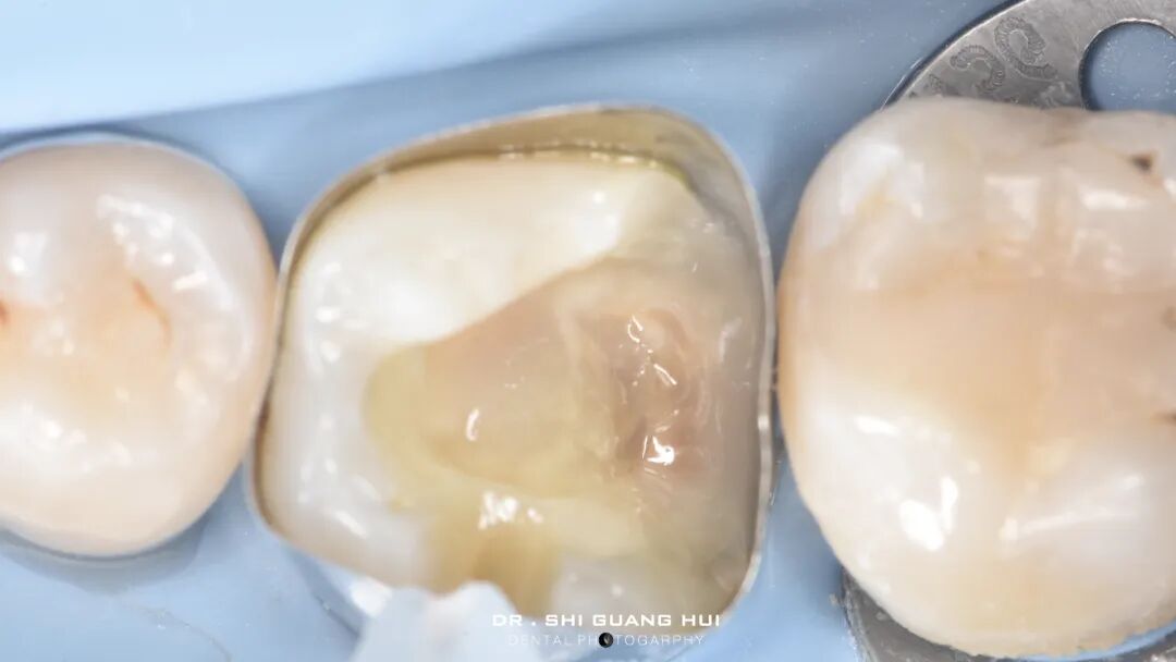 深边缘提升的再思考（龈壁提升的操作细节）