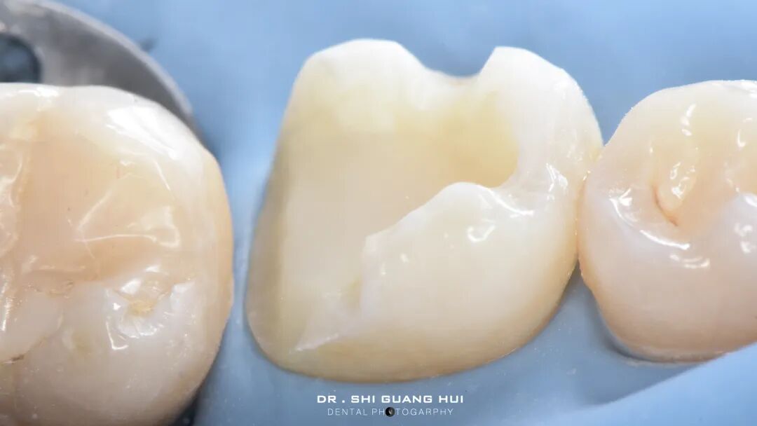 深边缘提升的再思考（龈壁提升的操作细节）