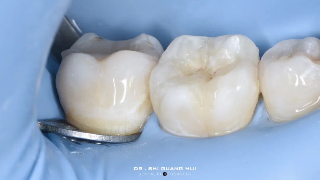 深边缘提升的再思考（龈壁提升的操作细节）