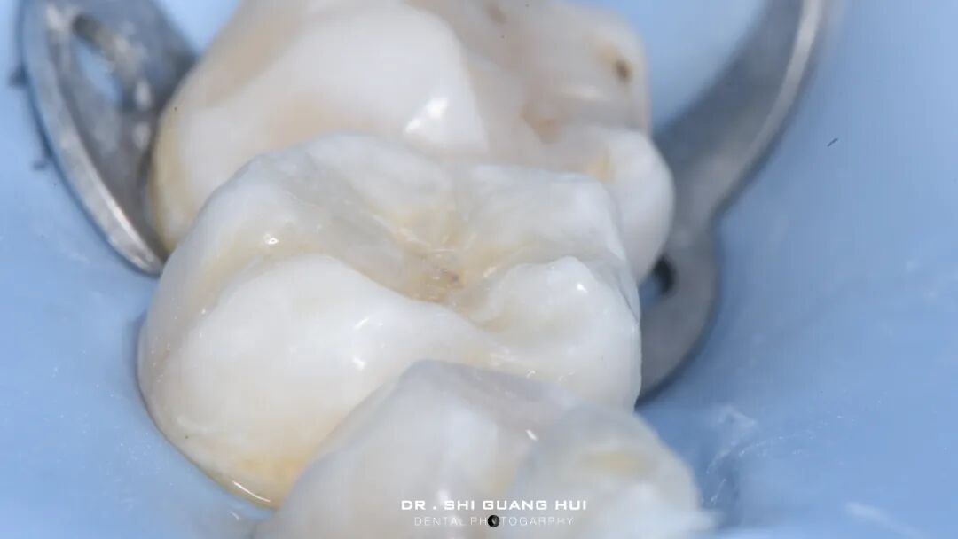 深边缘提升的再思考（龈壁提升的操作细节）