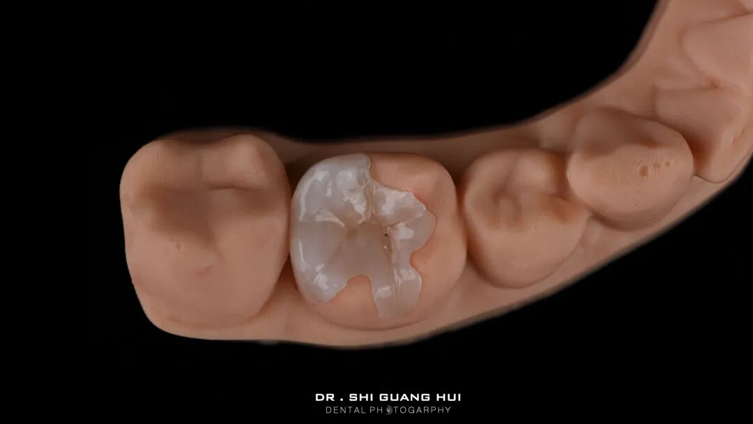 深边缘提升的再思考（龈壁提升的操作细节）