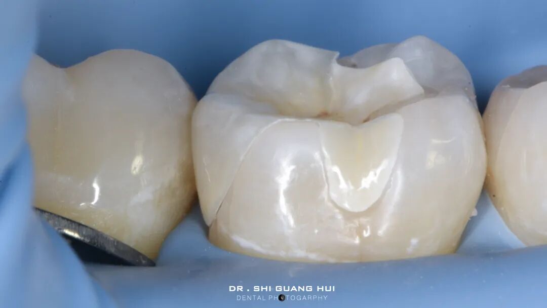 深边缘提升的再思考（龈壁提升的操作细节）