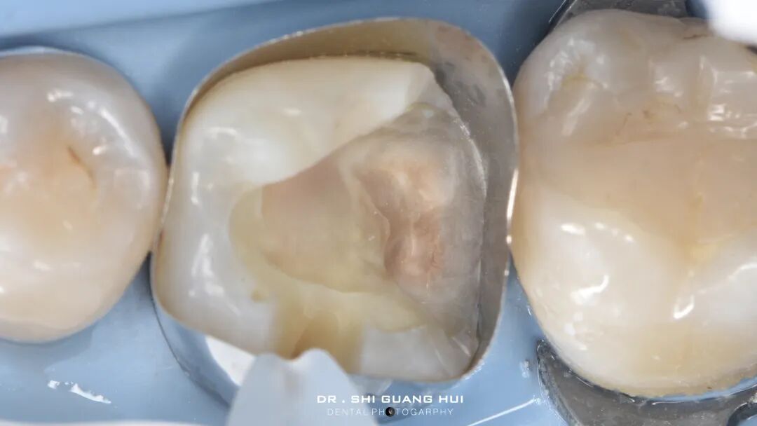 深边缘提升的再思考（龈壁提升的操作细节）