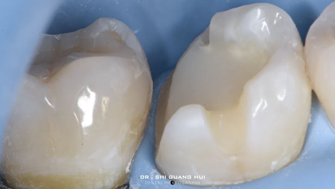 深边缘提升的再思考（龈壁提升的操作细节）