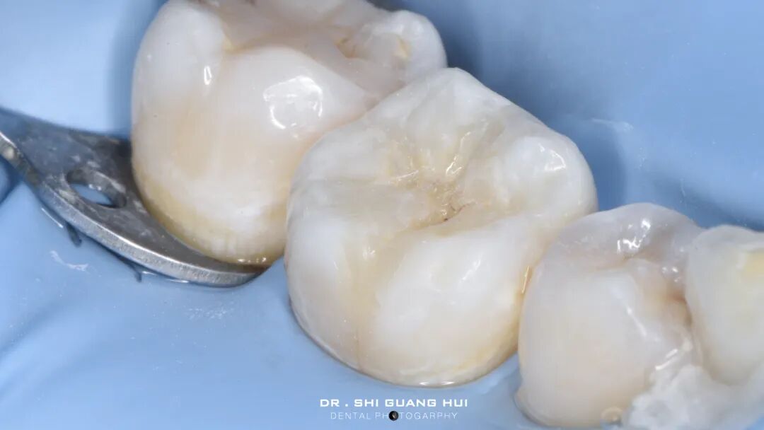 深边缘提升的再思考（龈壁提升的操作细节）