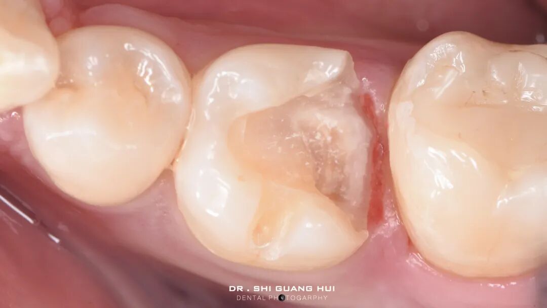 深边缘提升的再思考（龈壁提升的操作细节）