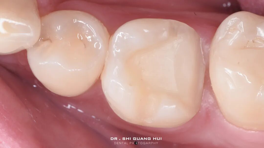 深边缘提升的再思考（龈壁提升的操作细节）