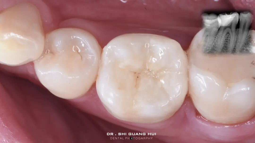 深边缘提升的再思考（龈壁提升的操作细节）