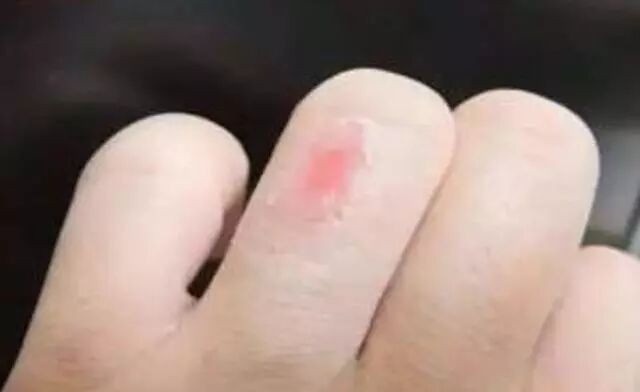 意外被烫伤了怎么办 简单教你一招 快速止疼不留疤 成长每一天 微信公众号文章阅读 Wemp