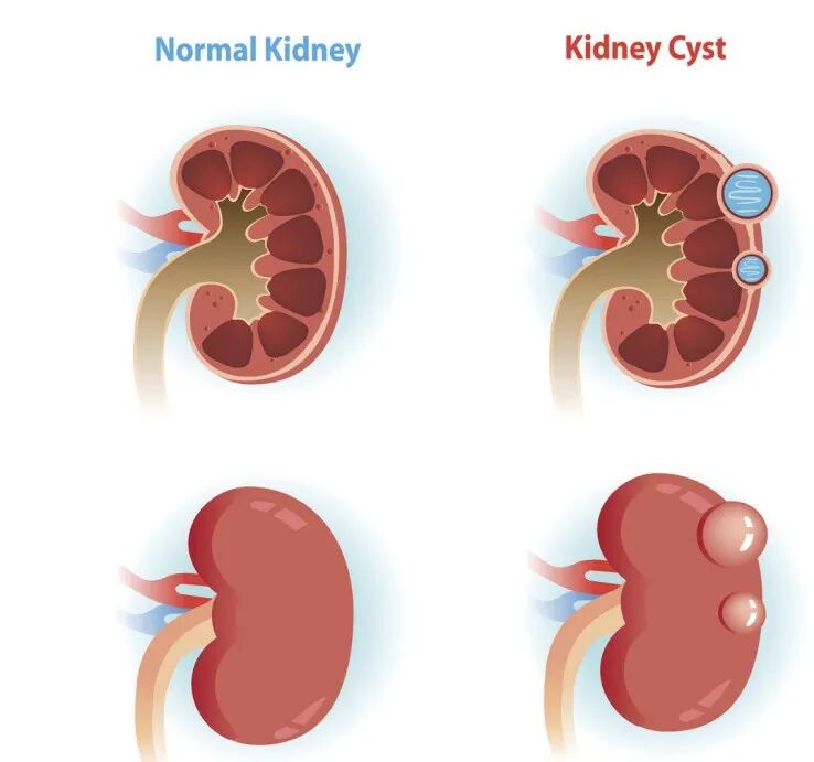 g穿刺怎么玩“一针多用”，浅谈FBN穿刺活检针的临床应用领域_https://www.jmylbn.com_新闻资讯_第5张