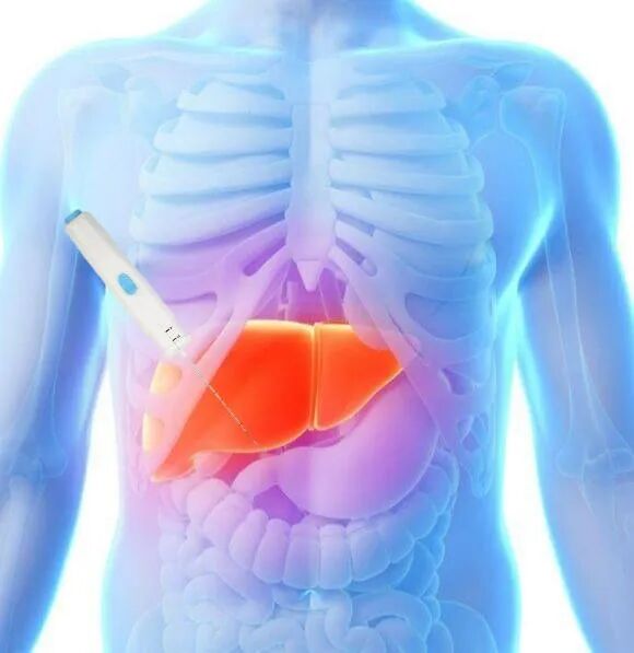 同轴定位针怎么使用软组织活检针的“黄金搭档”——同轴活检针_https://www.jmylbn.com_新闻资讯_第2张