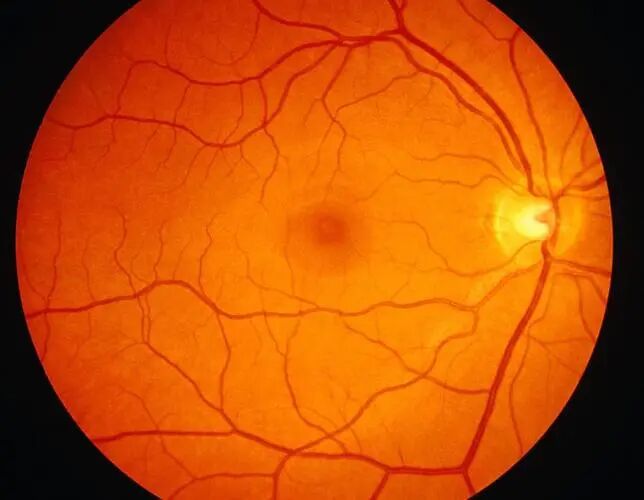 眼底照相能检查出什么教你如何看懂眼底检查_https://www.jmylbn.com_新闻资讯_第1张