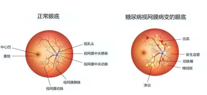 眼底照相能检查出什么教你如何看懂眼底检查_https://www.jmylbn.com_新闻资讯_第2张