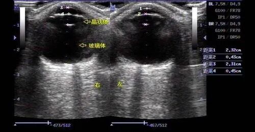 红光仪是什么【视光之窗】183期：近视红光治疗仪（哺光仪）的“洗牌”之路_https://www.jmylbn.com_新闻资讯_第19张