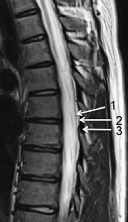 脊柱骨折的分型、诊断与治疗